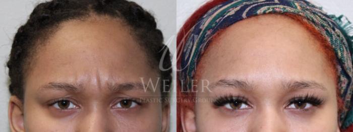 Before & After BOTOX® Cosmetic Case 696 Front  View in Baton Rouge, New Orleans, & Lafayette, Louisiana