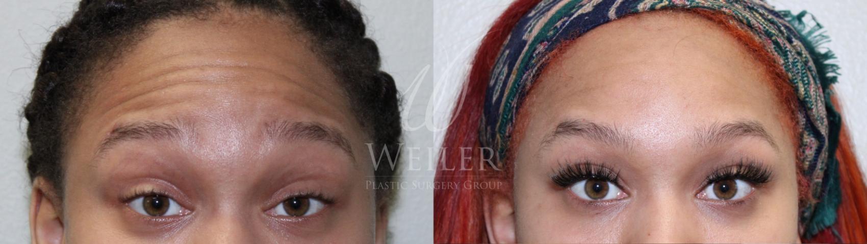 Before & After BOTOX® Cosmetic Case 696 Front View in Baton Rouge, New Orleans, & Lafayette, Louisiana
