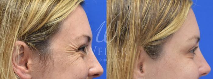 Before & After BOTOX® Cosmetic Case 758 Right Side View in Baton Rouge, New Orleans, & Lafayette, Louisiana