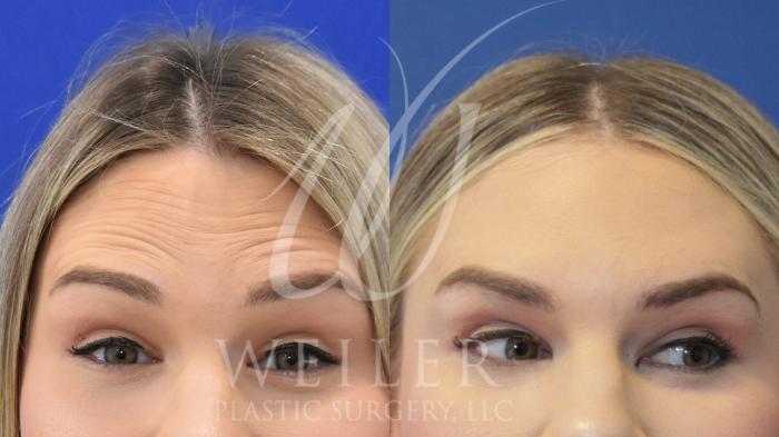 Before & After BOTOX® Cosmetic Case 905 Front View in Baton Rouge, New Orleans, & Lafayette, Louisiana