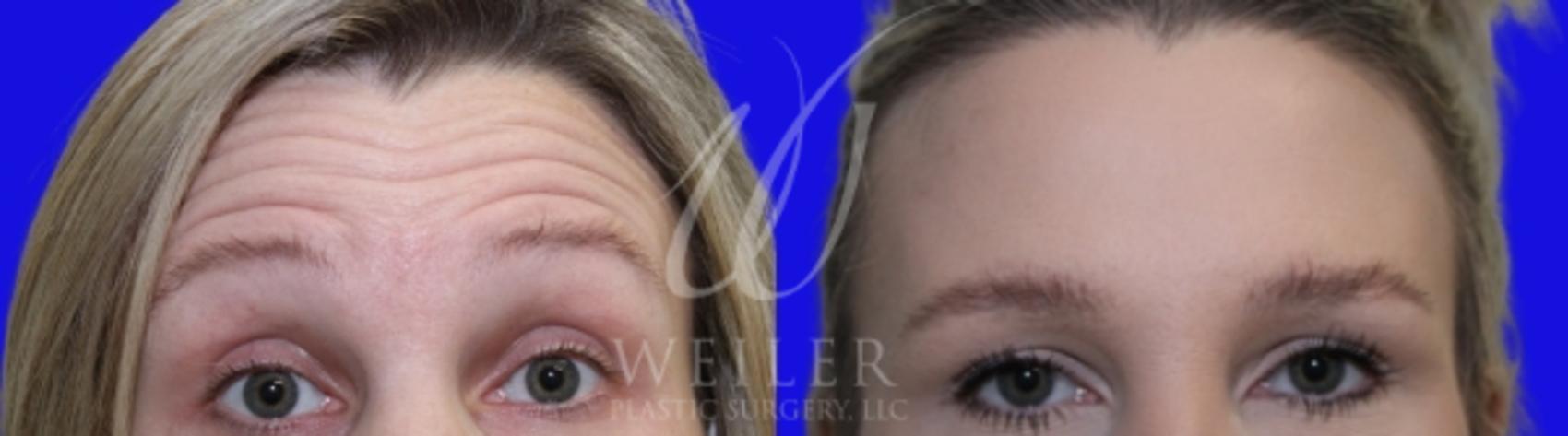 Before & After BOTOX® Cosmetic Case 987 Front View in Baton Rouge, New Orleans, & Lafayette, Louisiana