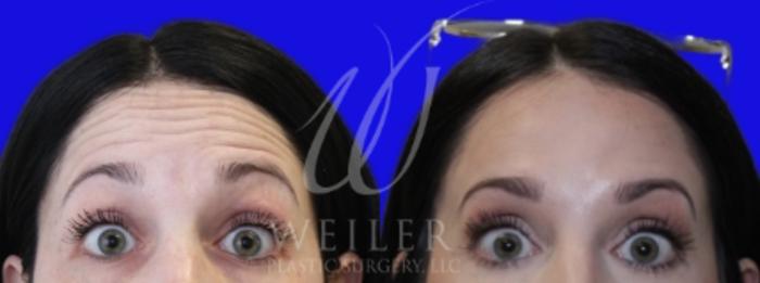 Before & After BOTOX® Cosmetic Case 989 Front View in Baton Rouge, Louisiana
