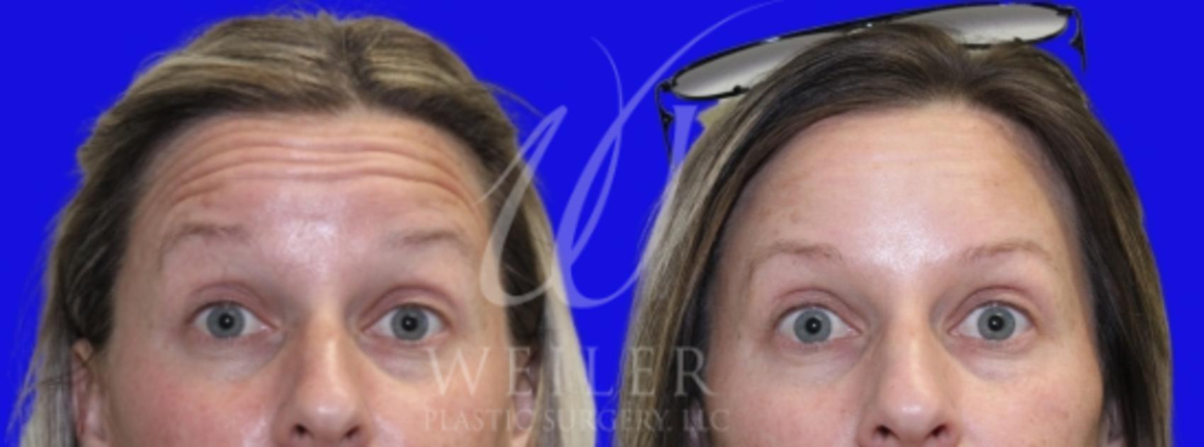 Before & After BOTOX® Cosmetic Case 990 Front View in Baton Rouge, Louisiana
