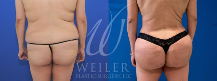 Before & After Brazilian Butt Lift Case 1063 Back View in Baton Rouge, New Orleans, & Lafayette, Louisiana