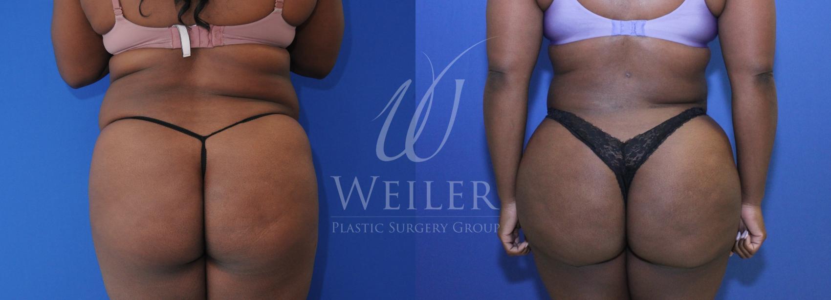 Before & After Brazilian Butt Lift Case 1126 Back View in Baton Rouge, New Orleans, & Lafayette, Louisiana