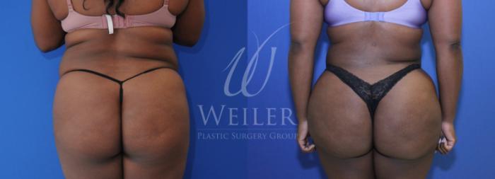 Before & After Brazilian Butt Lift Case 1126 Back View in Baton Rouge, New Orleans, & Lafayette, Louisiana