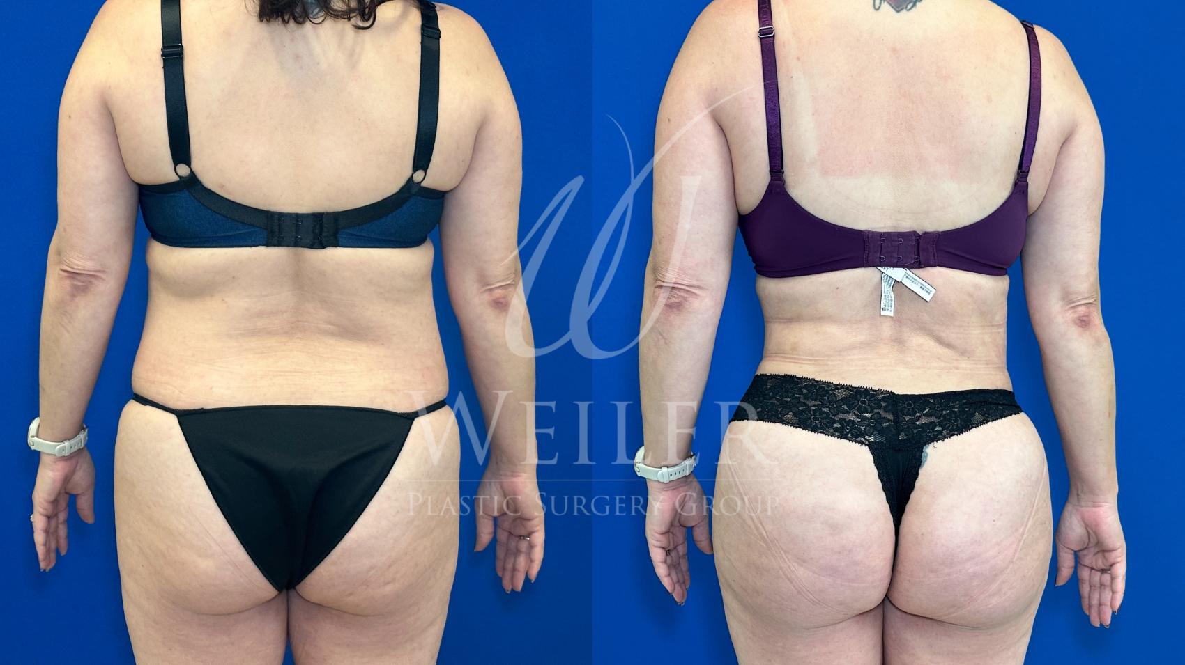 Before & After Brazilian Butt Lift Case 1170 Back View in Baton Rouge, New Orleans, & Lafayette, Louisiana