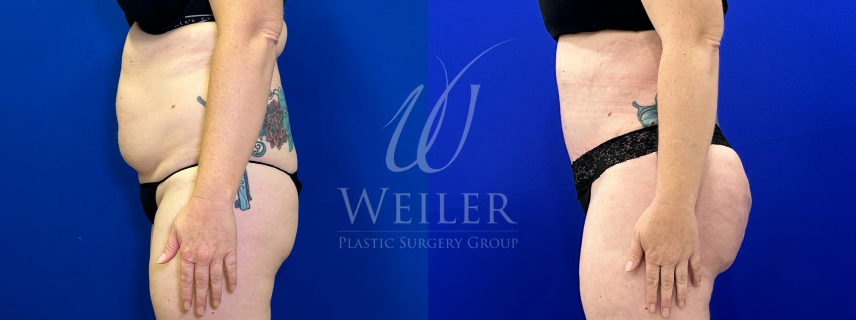 Before & After Tummy Tuck Case 1525 Left Side View in Baton Rouge, New Orleans, & Lafayette, Louisiana