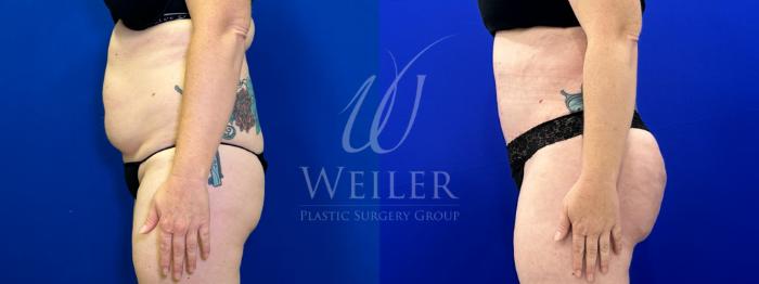Before & After Tummy Tuck Case 1525 Left Side View in Baton Rouge, New Orleans, & Lafayette, Louisiana