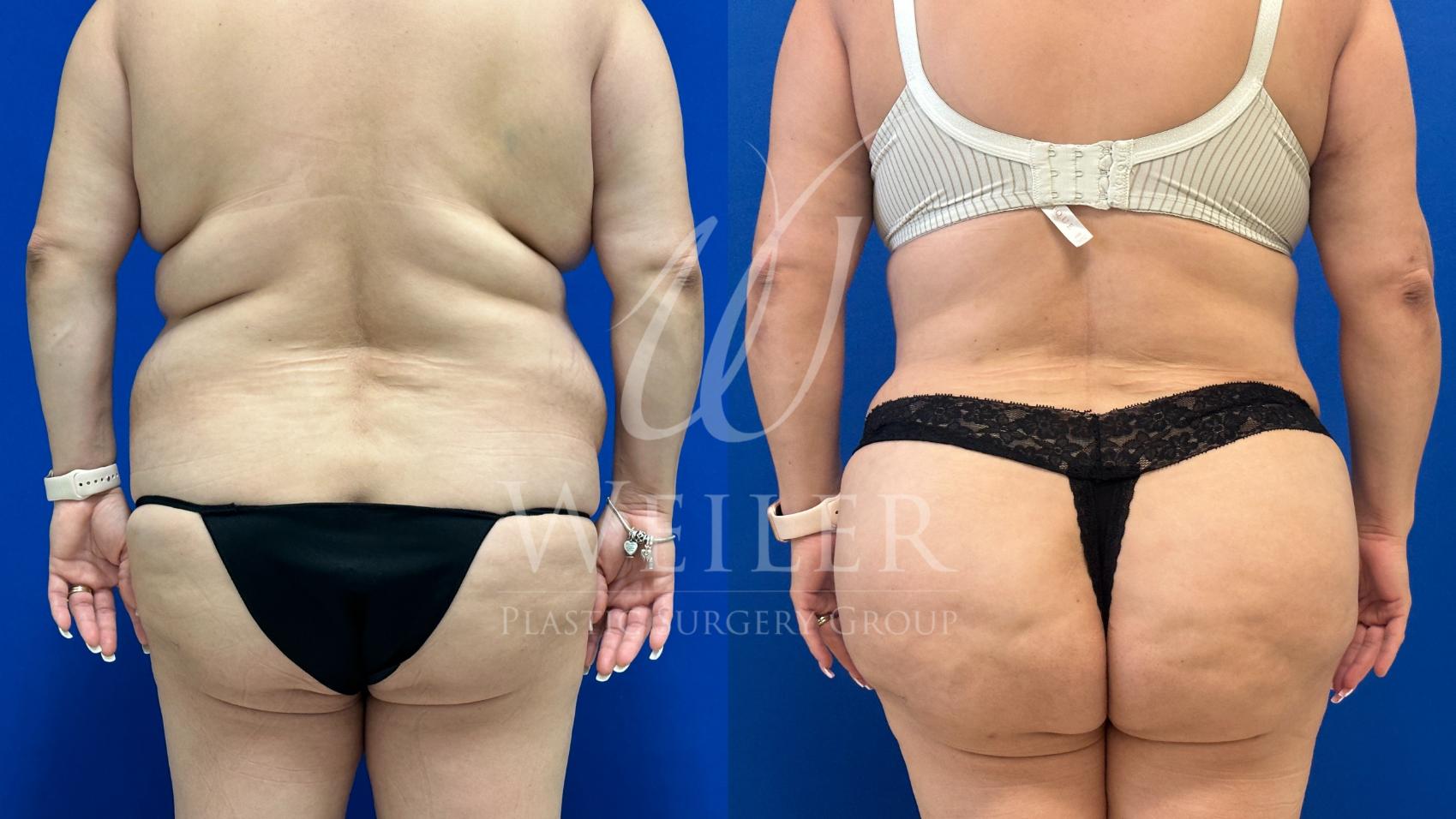 Before & After Brazilian Butt Lift Case 1552 Back View in Baton Rouge, New Orleans, & Lafayette, Louisiana
