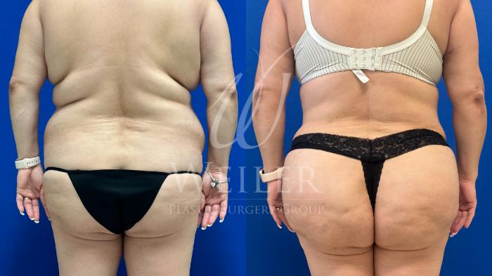 Before & After Brazilian Butt Lift Case 1552 Back View in Baton Rouge, New Orleans, & Lafayette, Louisiana