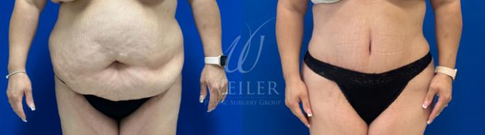 Before & After Brazilian Butt Lift Case 1552 Front View in Baton Rouge, New Orleans, & Lafayette, Louisiana