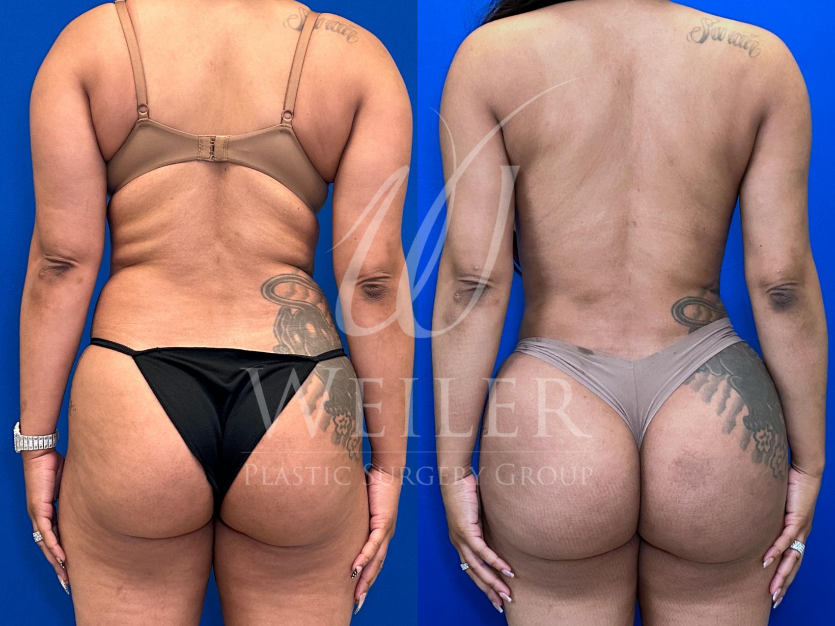 Before & After Liposuction Case 1691 Back View in Baton Rouge, New Orleans, & Lafayette, Louisiana