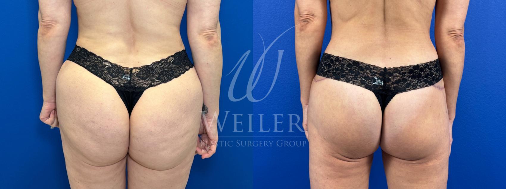 Before & After Brazilian Butt Lift Case 1717 Back View in Baton Rouge, New Orleans, & Lafayette, Louisiana