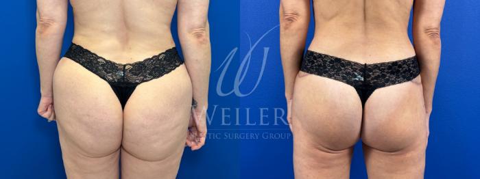 Before & After Brazilian Butt Lift Case 1717 Back View in Baton Rouge, New Orleans, & Lafayette, Louisiana
