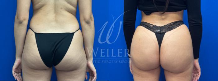 Before & After Brazilian Butt Lift Case 1720 Back View in Baton Rouge, New Orleans, & Lafayette, Louisiana