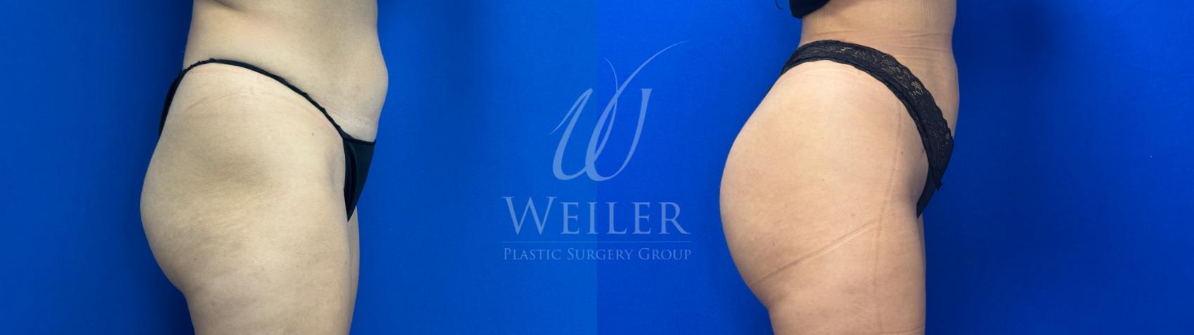 Before & After Brazilian Butt Lift Case 1720 Right Side View in Baton Rouge, New Orleans, & Lafayette, Louisiana