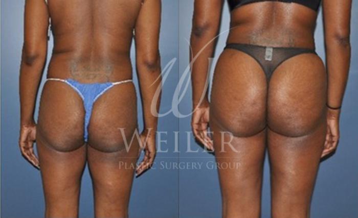 Before & After Brazilian Butt Lift Case 41 View #1 View in Baton Rouge, Louisiana