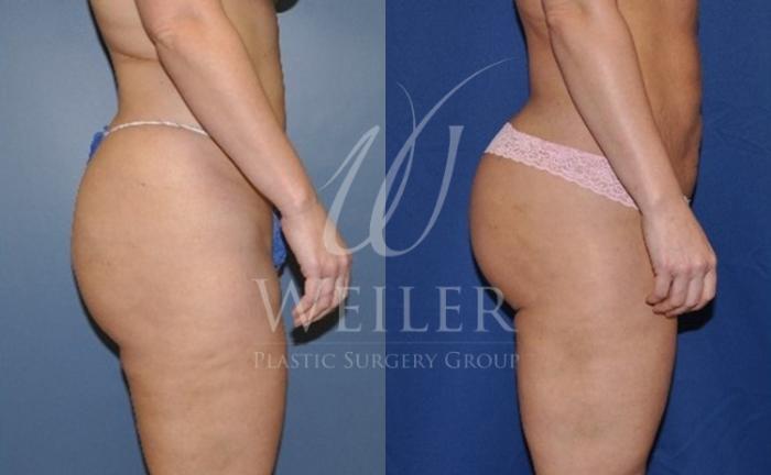 Before & After Brazilian Butt Lift Case 44 View #1 View in Baton Rouge, New Orleans, & Lafayette, Louisiana