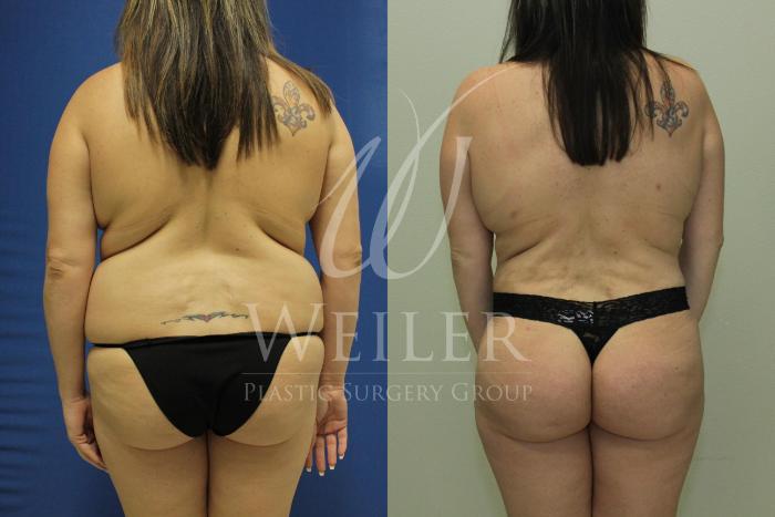 Before & After Brazilian Butt Lift Case 515 Back View in Baton Rouge, New Orleans, & Lafayette, Louisiana