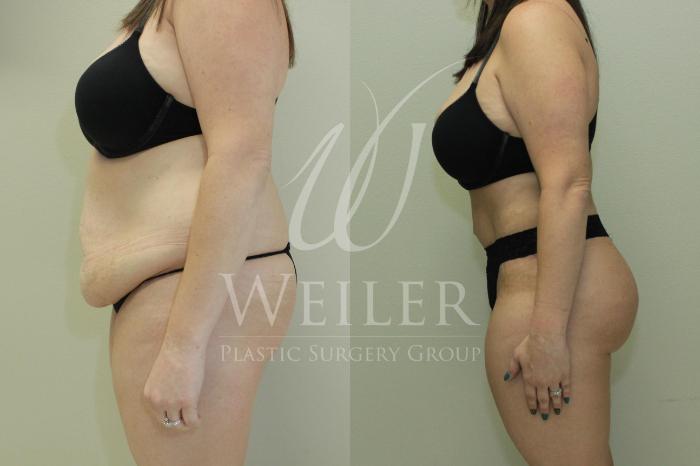 Before & After Brazilian Butt Lift Case 515 Left Side View in Baton Rouge, New Orleans, & Lafayette, Louisiana