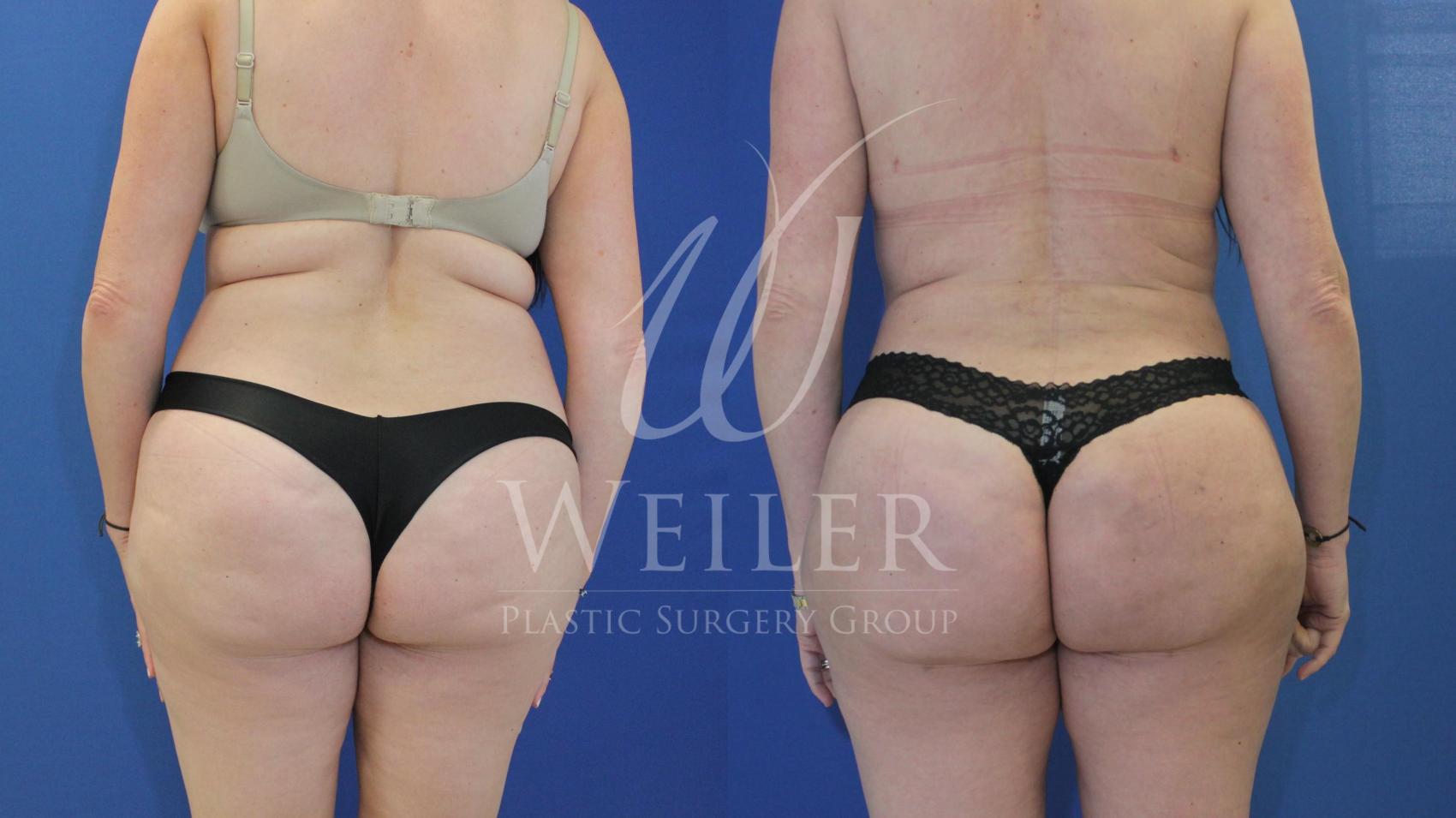Before & After Brazilian Butt Lift Case 536 Back View in Baton Rouge, New Orleans, & Lafayette, Louisiana