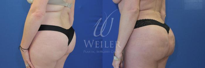 Before & After Brazilian Butt Lift Case 536 Left Side View in Baton Rouge, New Orleans, & Lafayette, Louisiana