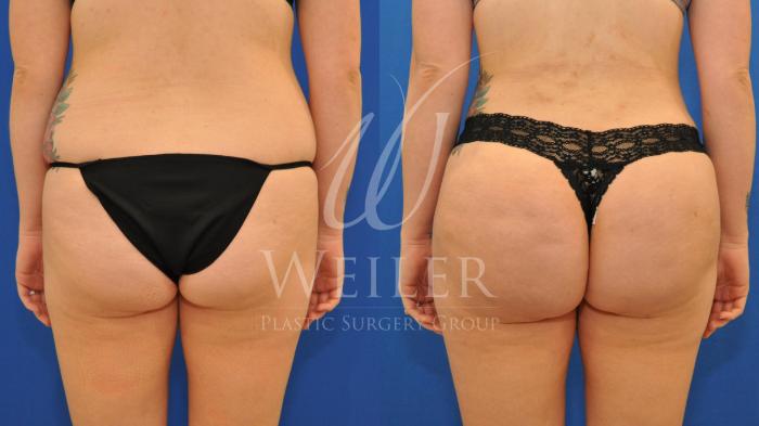 Before & After Brazilian Butt Lift Case 545 Back View in Baton Rouge, New Orleans, & Lafayette, Louisiana
