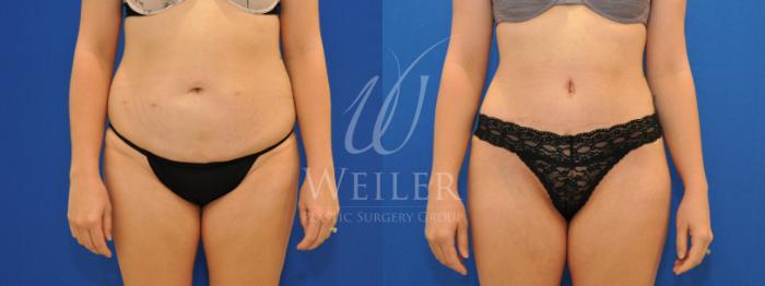 Before & After Brazilian Butt Lift Case 545 Front View in Baton Rouge, New Orleans, & Lafayette, Louisiana