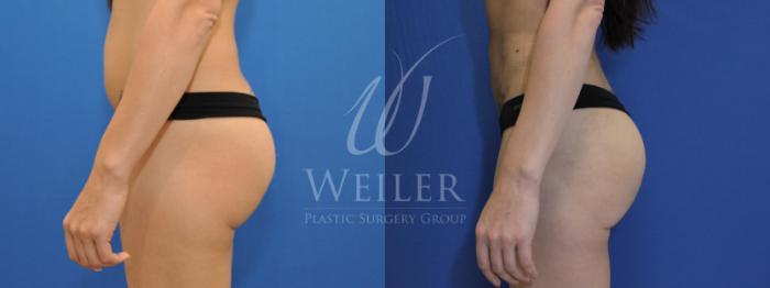 Before & After Brazilian Butt Lift Case 555 Left Side View in Baton Rouge, Louisiana