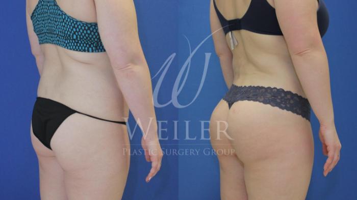 Before & After Brazilian Butt Lift Case 592 Right Oblique View in Baton Rouge, Louisiana