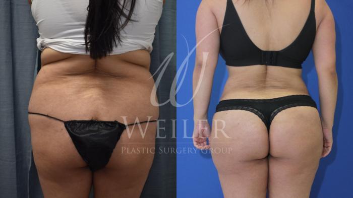 Before & After Brazilian Butt Lift Case 640 Back View in Baton Rouge, New Orleans, & Lafayette, Louisiana