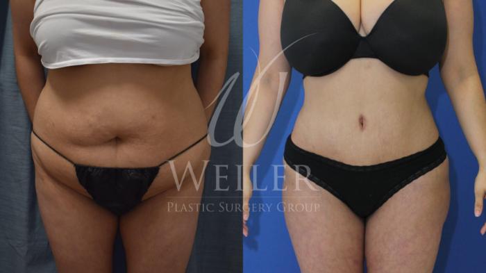 Before & After Brazilian Butt Lift Case 640 Front View in Baton Rouge, New Orleans, & Lafayette, Louisiana