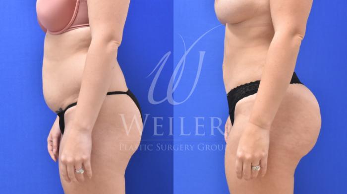 Before & After Brazilian Butt Lift Case 642 Left Side View in Baton Rouge, Louisiana