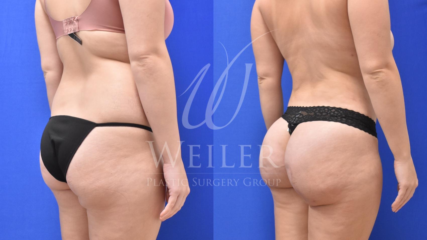 Before & After Brazilian Butt Lift Case 642 Right Oblique View in Baton Rouge, Louisiana