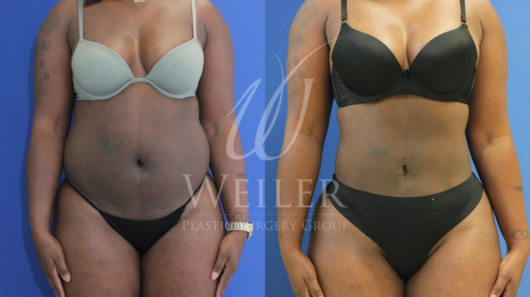 Before & After Brazilian Butt Lift Case 660 Front View in Baton Rouge, Louisiana
