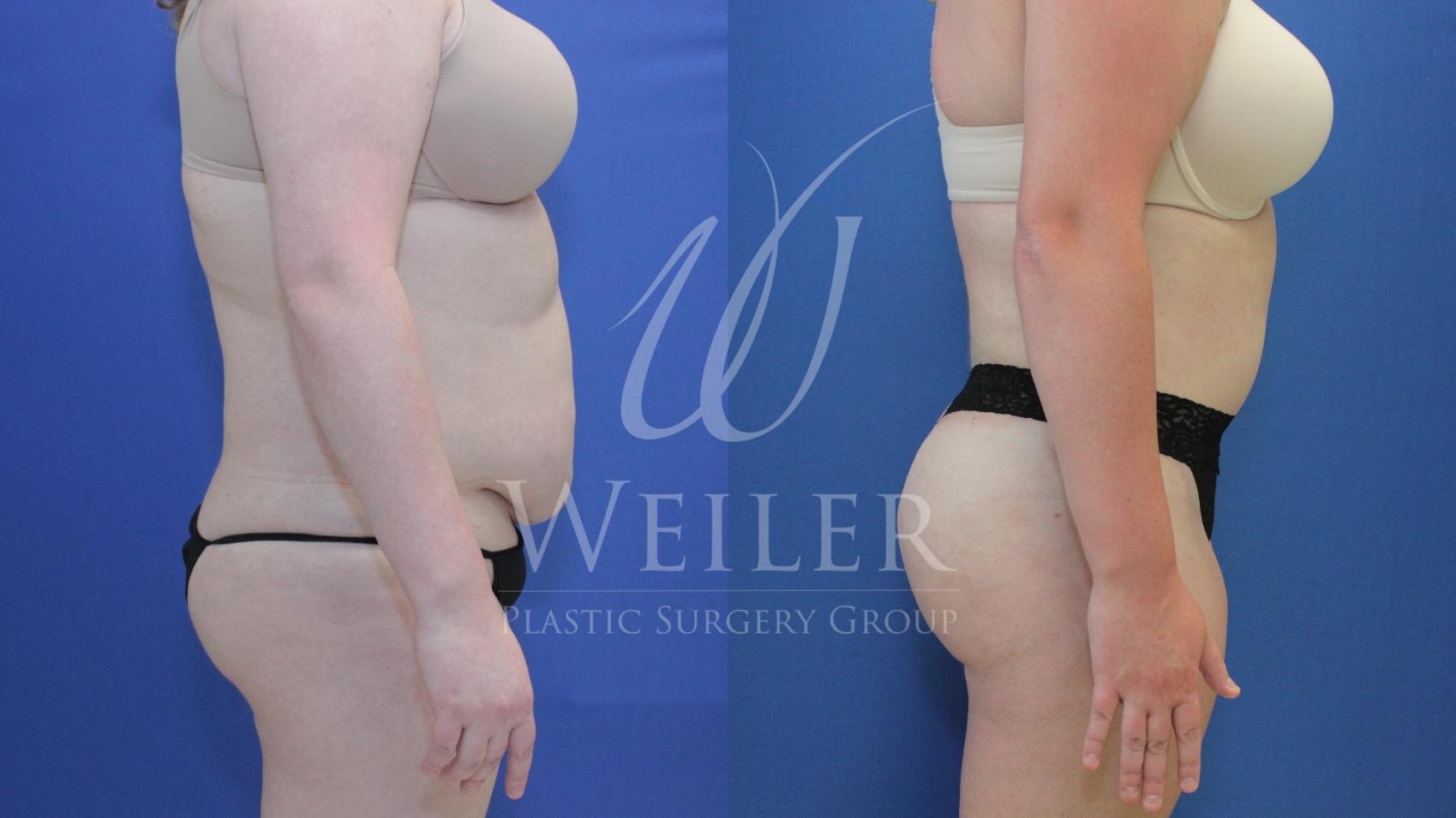 Before & After Brazilian Butt Lift Case 673 Right Side View in Baton Rouge, Louisiana