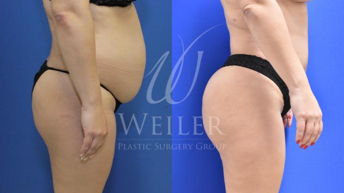 Before & After Brazilian Butt Lift Case 676 Right Side View in Baton Rouge, New Orleans, & Lafayette, Louisiana