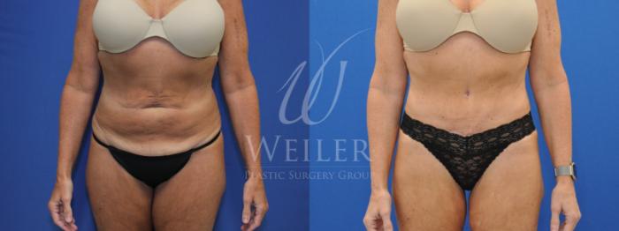 Before & After Brazilian Butt Lift Case 689 Front View in Baton Rouge, New Orleans, & Lafayette, Louisiana