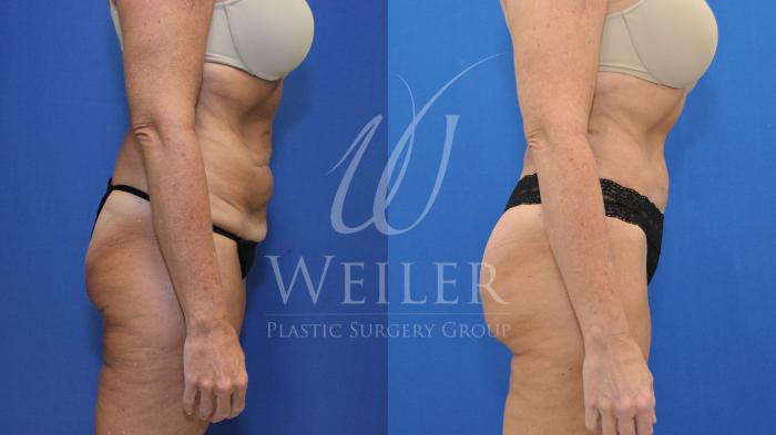 Before & After Brazilian Butt Lift Case 689 Right Side View in Baton Rouge, New Orleans, & Lafayette, Louisiana