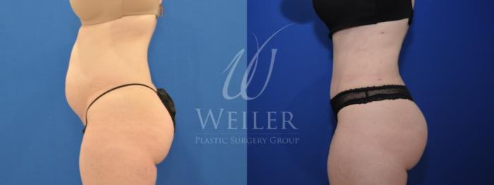 Before & After Brazilian Butt Lift Case 690 Left Side View in Baton Rouge, Louisiana