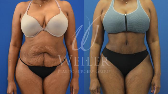 Before & After Brazilian Butt Lift Case 704 Front View in Baton Rouge, Louisiana