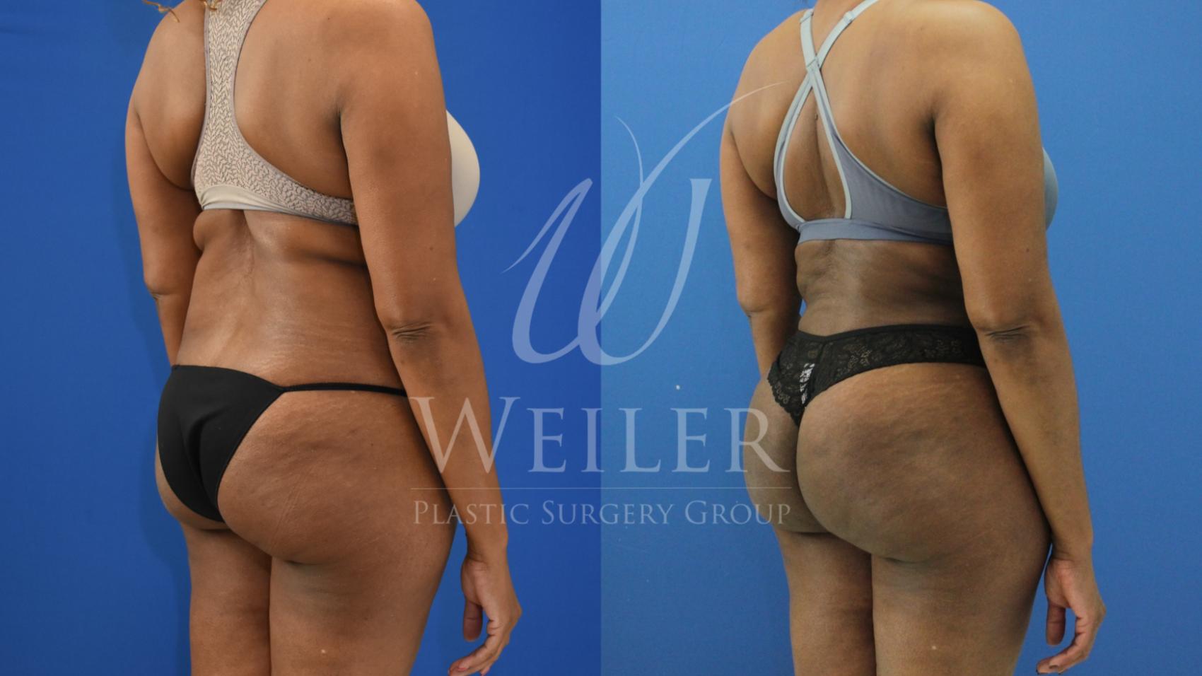 Before & After Brazilian Butt Lift Case 704 Right Oblique View in Baton Rouge, Louisiana