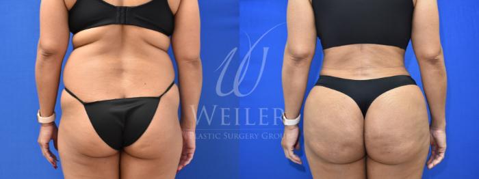 Before & After Brazilian Butt Lift Case 715 Back View in Baton Rouge, New Orleans, & Lafayette, Louisiana
