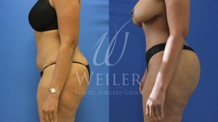 Before & After Brazilian Butt Lift Case 753 Left Side View in Baton Rouge, Louisiana