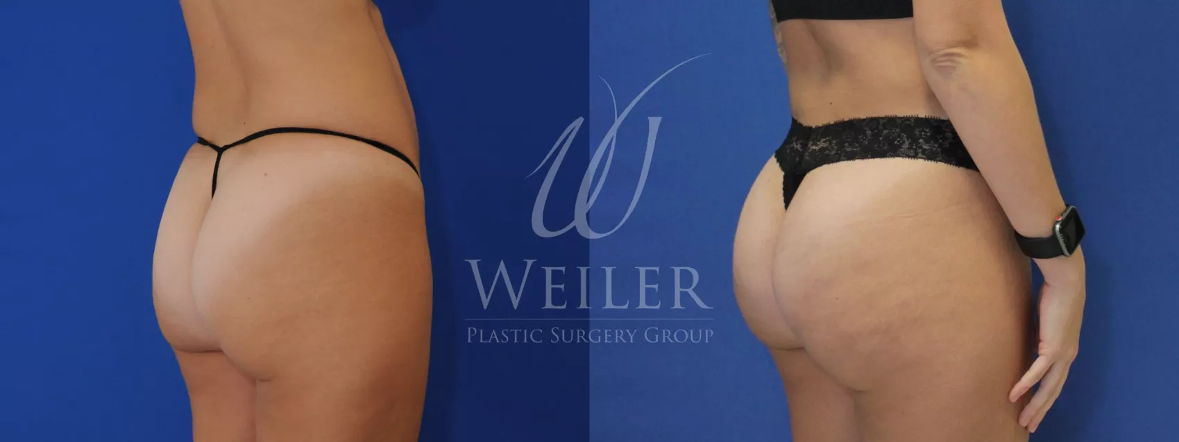 Brazilian Butt Lift Before and After Pictures Case 809