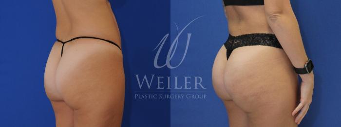 Before & After Brazilian Butt Lift Case 809 Right Oblique View in Baton Rouge, Louisiana