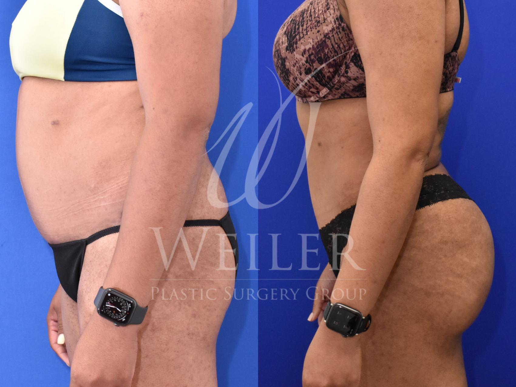 Before & After Brazilian Butt Lift Case 861 Left Side View in Baton Rouge, Louisiana