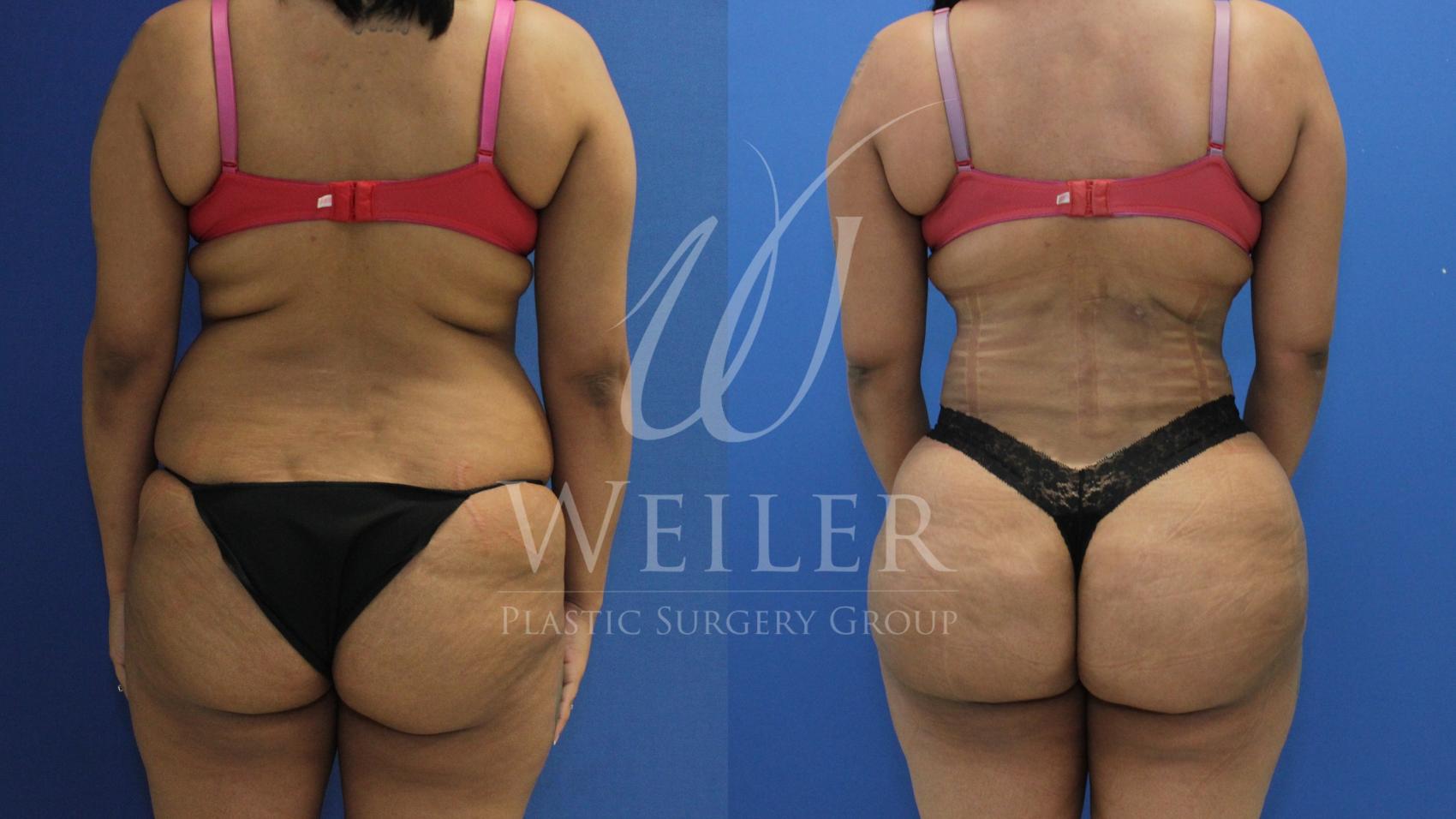 Before & After Brazilian Butt Lift Case 874 Back View in Baton Rouge, New Orleans, & Lafayette, Louisiana