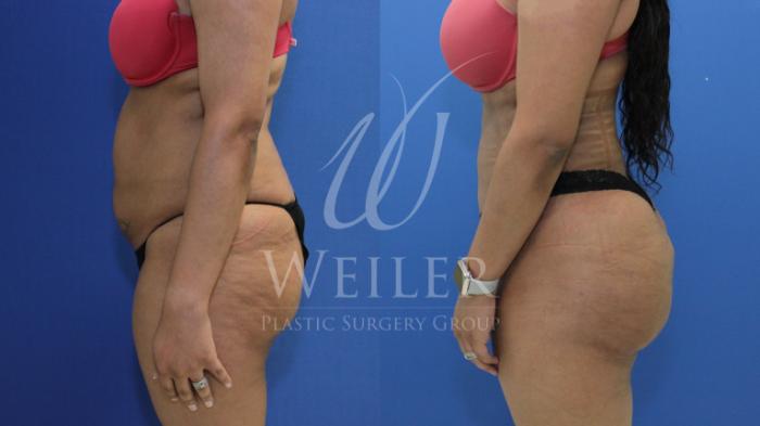 Before & After Brazilian Butt Lift Case 874 Left Side View in Baton Rouge, New Orleans, & Lafayette, Louisiana